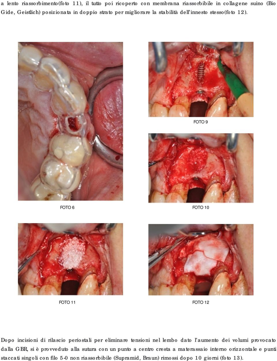 FOTO 9 FOTO 6 FOTO 10 FOTO 11 FOTO 12 Dopo incisioni di rilascio periostali per eliminare tensioni nel lembo dato l aumento dei volumi