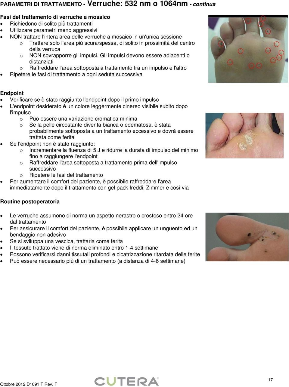 Gli impulsi devono essere adiacenti o distanziati o Raffreddare l'area sottoposta a trattamento tra un impulso e l'altro Ripetere le fasi di trattamento a ogni seduta successiva Endpoint Verificare