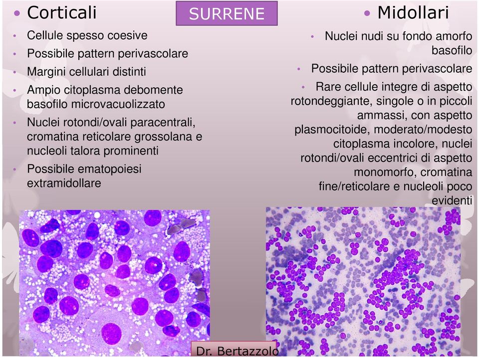 su fondo amorfo basofilo Possibile pattern perivascolare Rare cellule integre di aspetto rotondeggiante, singole o in piccoli ammassi, con aspetto