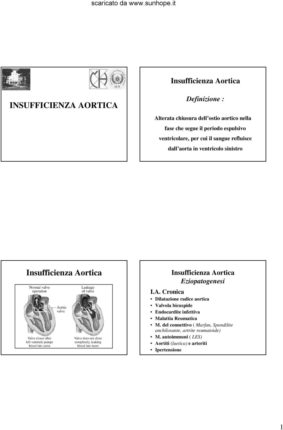 Cronica Dilatazione radice aortica Valvola bicuspide Endocardite infettiva Malattia Reumatica M.