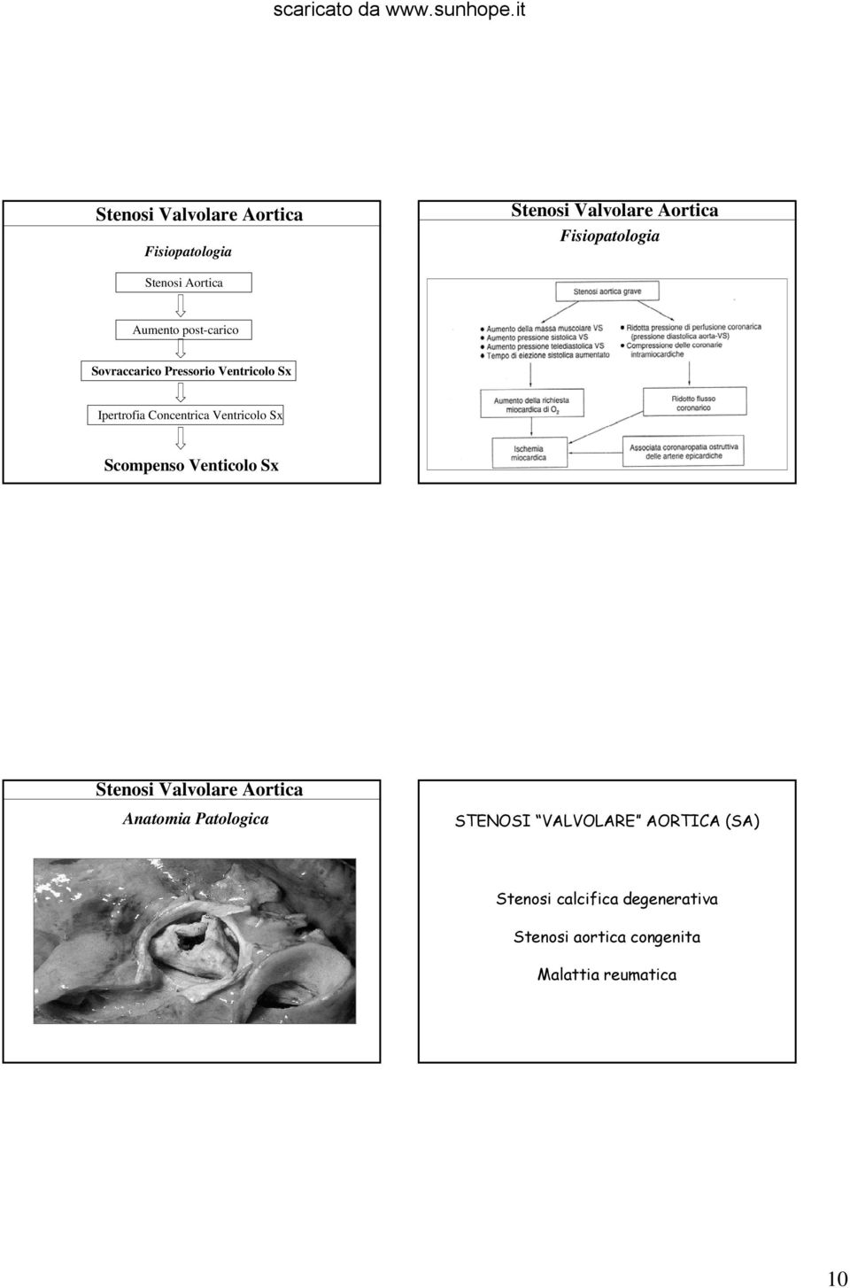 Sx Scompenso Venticolo Sx Anatomia Patologica STENOSI VALVOLARE AORTICA