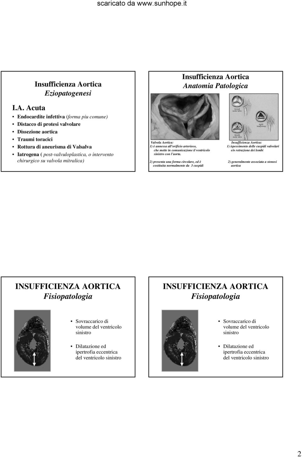 ventricolo e/o retrazione dei lembi sinistro con l aorta.