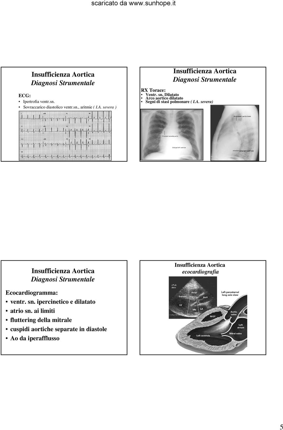 Dilatato Arco aortico dilatato Segni di stasi polmonare ( I.A. severa) Diagnosi Strumentale ecocardiografia Ecocardiogramma: ventr.