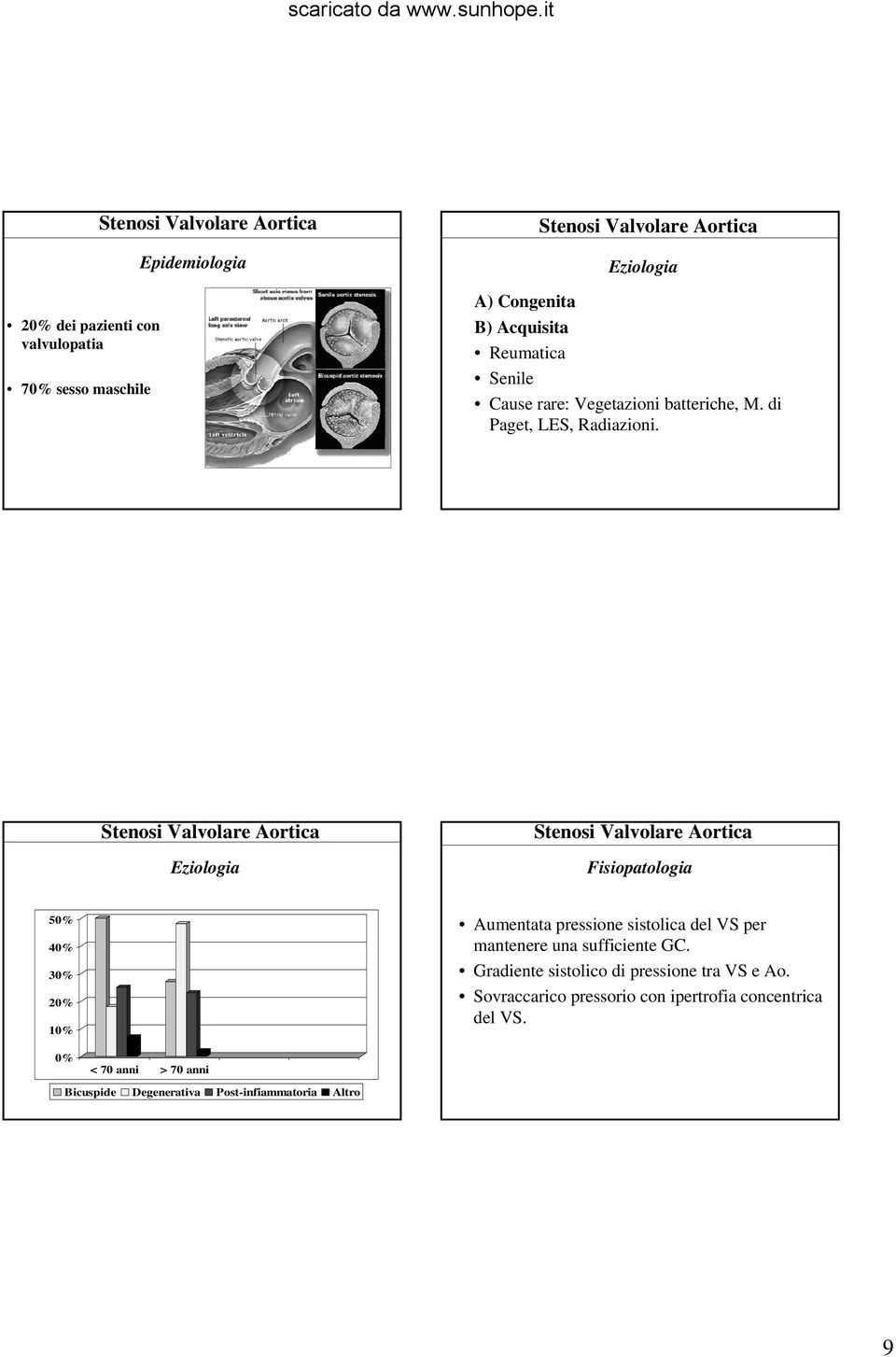 Eziologia Fisiopatologia 50% 40% 30% 20% 10% Aumentata pressione sistolica del VS per mantenere una sufficiente GC.