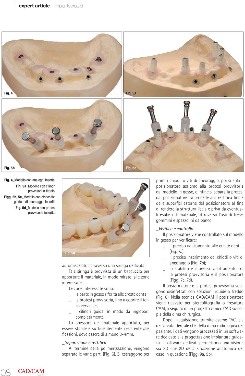 Le zone interessate sono: la parte in gesso riferita alle creste dentali; la protesi provvisoria, fino a coprire il terzo cervicale; _ i cilindri guida, in modo da inglobarli completamente.