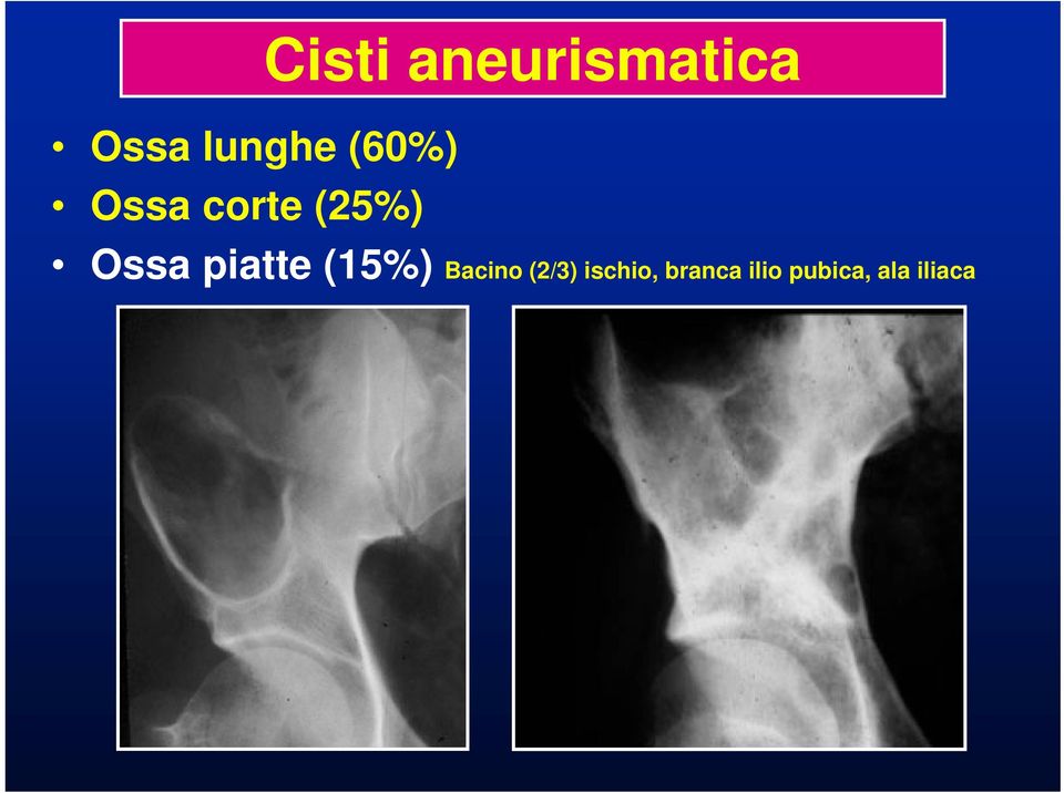 Ossa piatte (15%) Bacino (2/3)