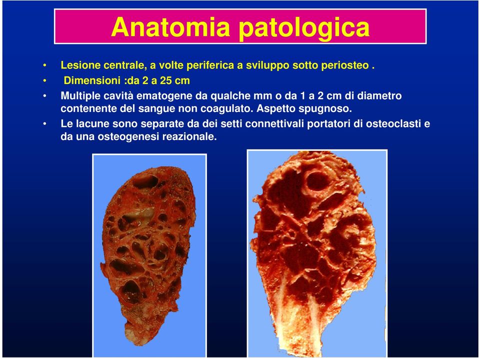 diametro contenente del sangue non coagulato. Aspetto spugnoso.