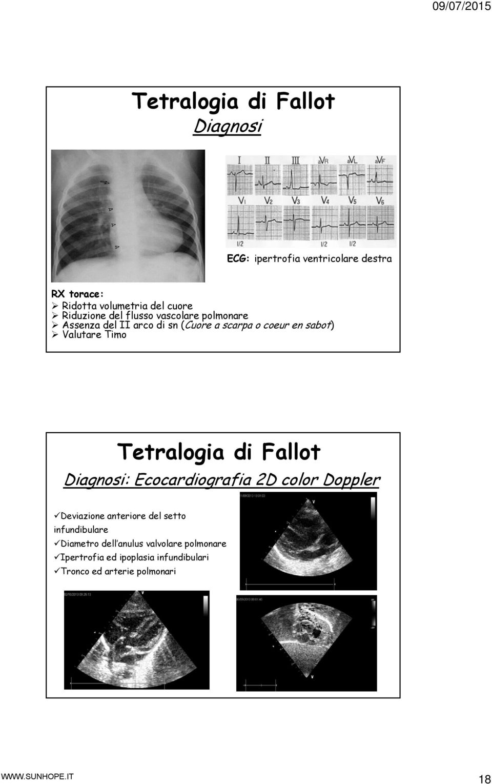 Timo Tetralogia di Fallot Diagnosi: Ecocardiografia 2D color Doppler Deviazione anteriore del setto