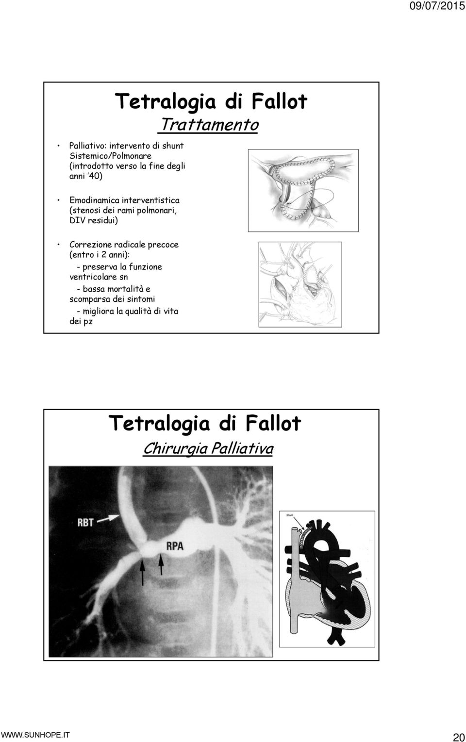 Correzione radicale precoce (entro i 2 anni): - preserva la funzione ventricolare sn - bassa