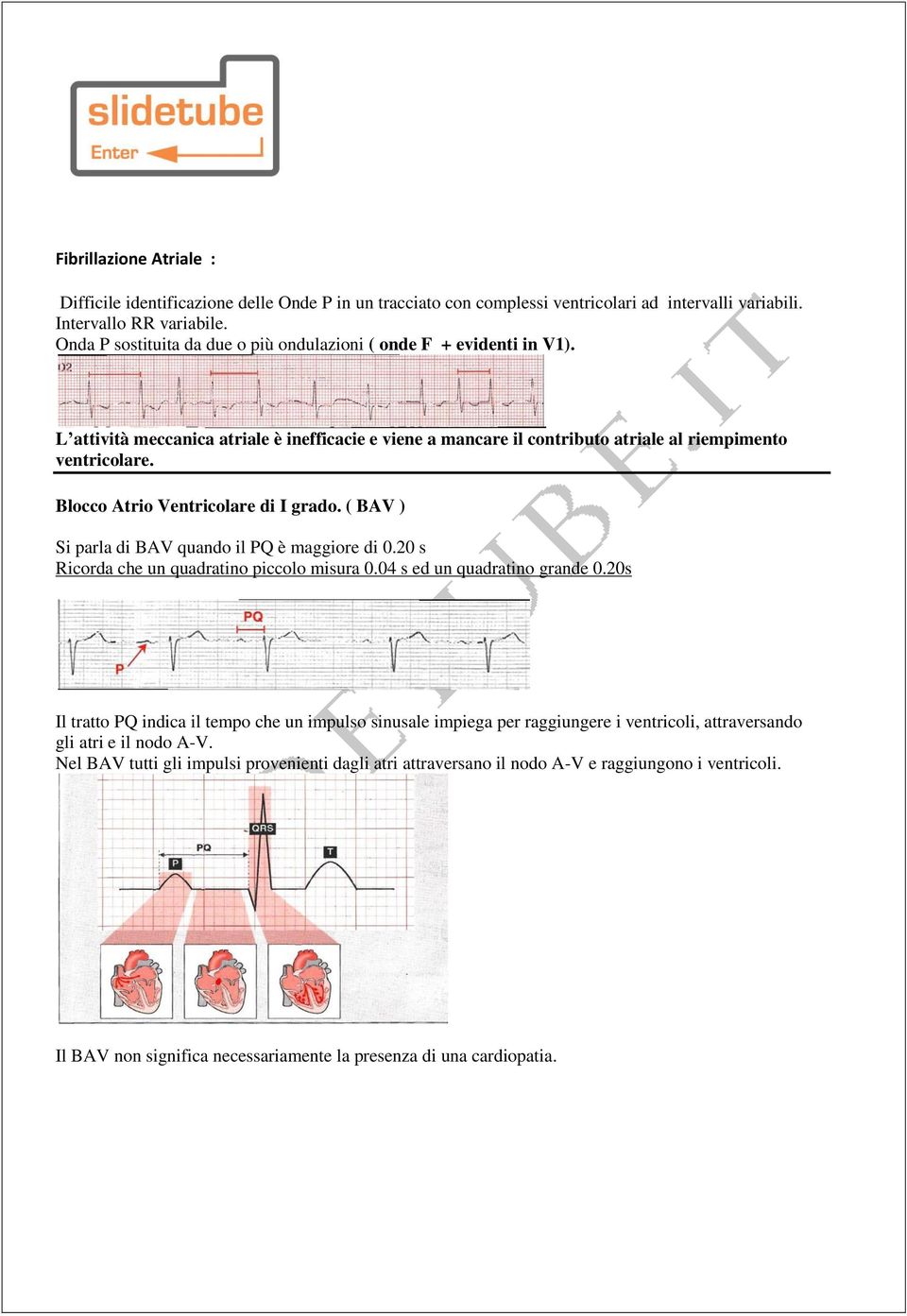 Blocco Atrio Ventricolare di I grado. ( BAV ) Si parla di BAV quando il PQ è maggiore di 0.20 s Ricorda che un quadratino piccolo misura 0.04 s ed un quadratino grande 0.