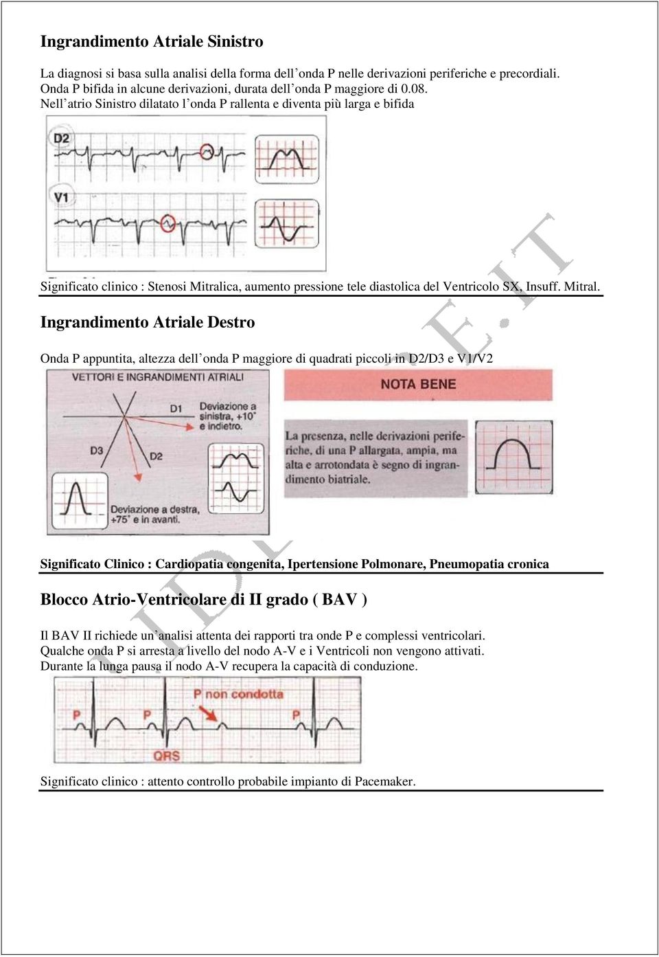 Nell atrio Sinistro dilatato l onda P rallenta e diventa più larga e bifida Significato clinico : Stenosi Mitrali