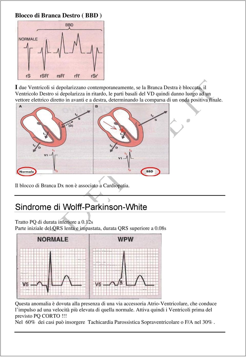 Sindrome di Wolff-Parkinson-White Tratto PQ di durata inferiore a 0.12s Parte iniziale del QRS lenta e impastata, durata QRS superiore a 0.