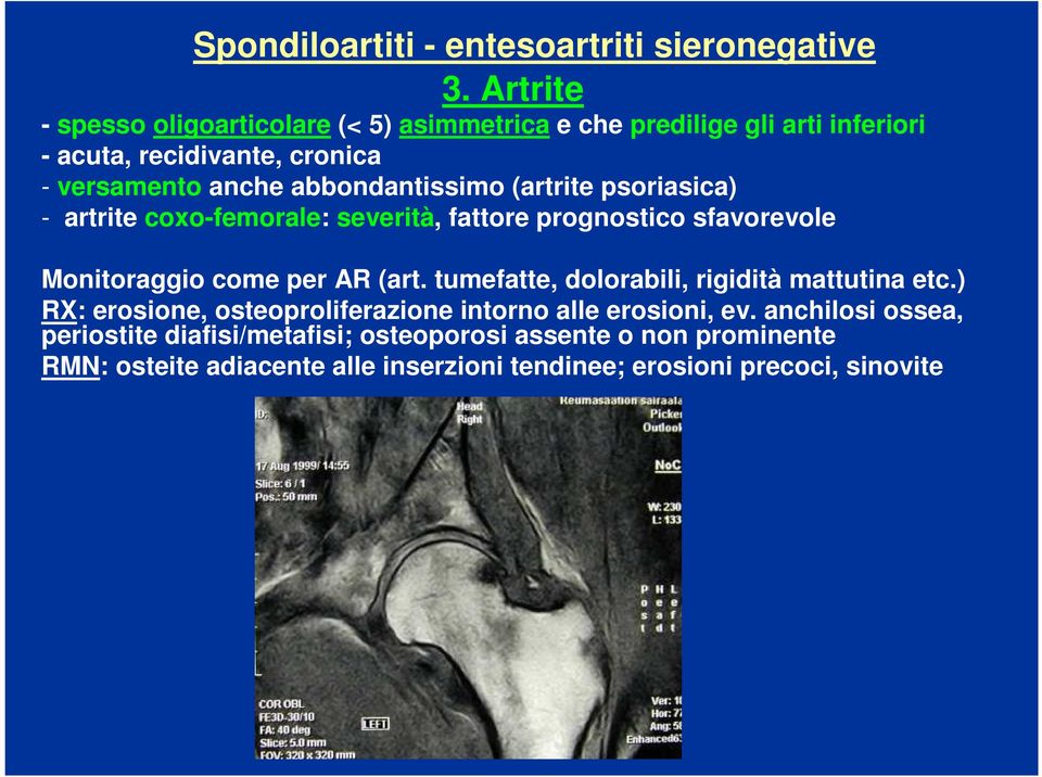 abbondantissimo (artrite psoriasica) - artrite coxo-femorale: severità, fattore prognostico sfavorevole Monitoraggio come per AR (art.