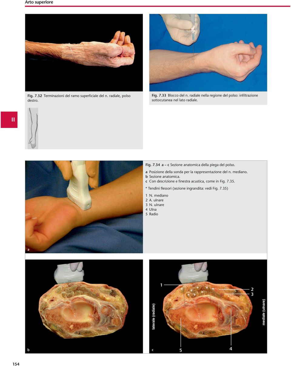 a Posizione della sonda per la rappresentazione del n. mediano. b Sezione anatomica.