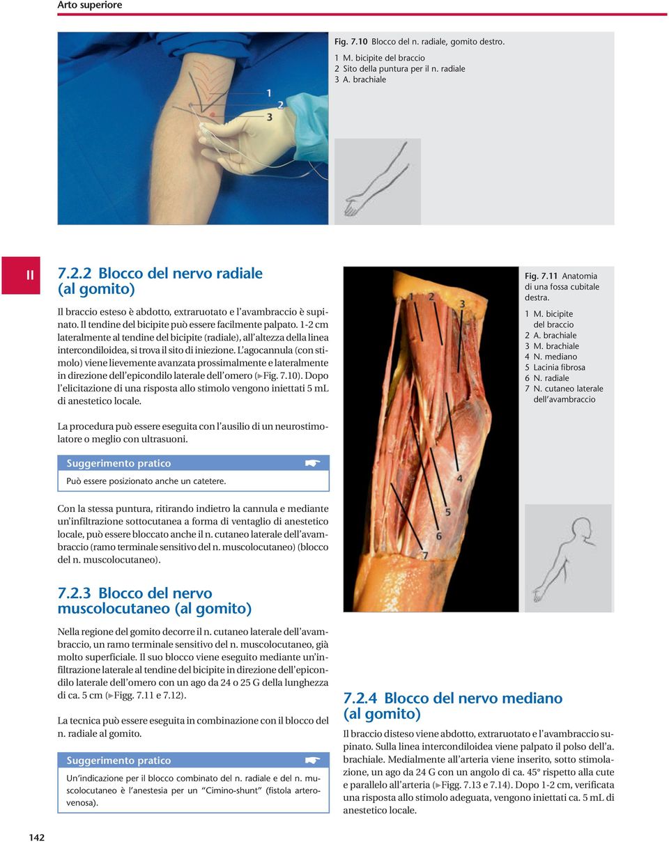 L agocannula (con stimolo) viene lievemente avanzata prossimalmente e lateralmente in direzione dell epicondilo laterale dell omero ( Fig. 7.10).