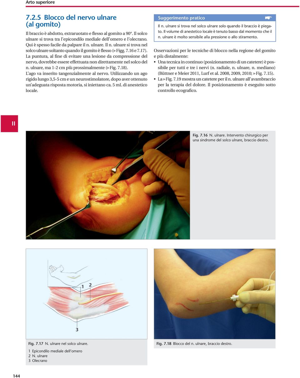 La puntura, al fine di evitare una lesione da compressione del nervo, dovrebbe essere effettuata non direttamente nel solco del n. ulnare, ma 1-2 cm più prossimalmente ( Fig. 7.18).