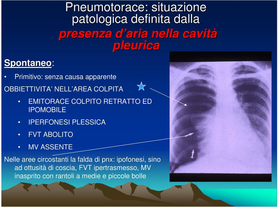 ABOLITO MV ASSENTE Nelle aree circostanti la falda di pnx: ipofonesi, sino ad