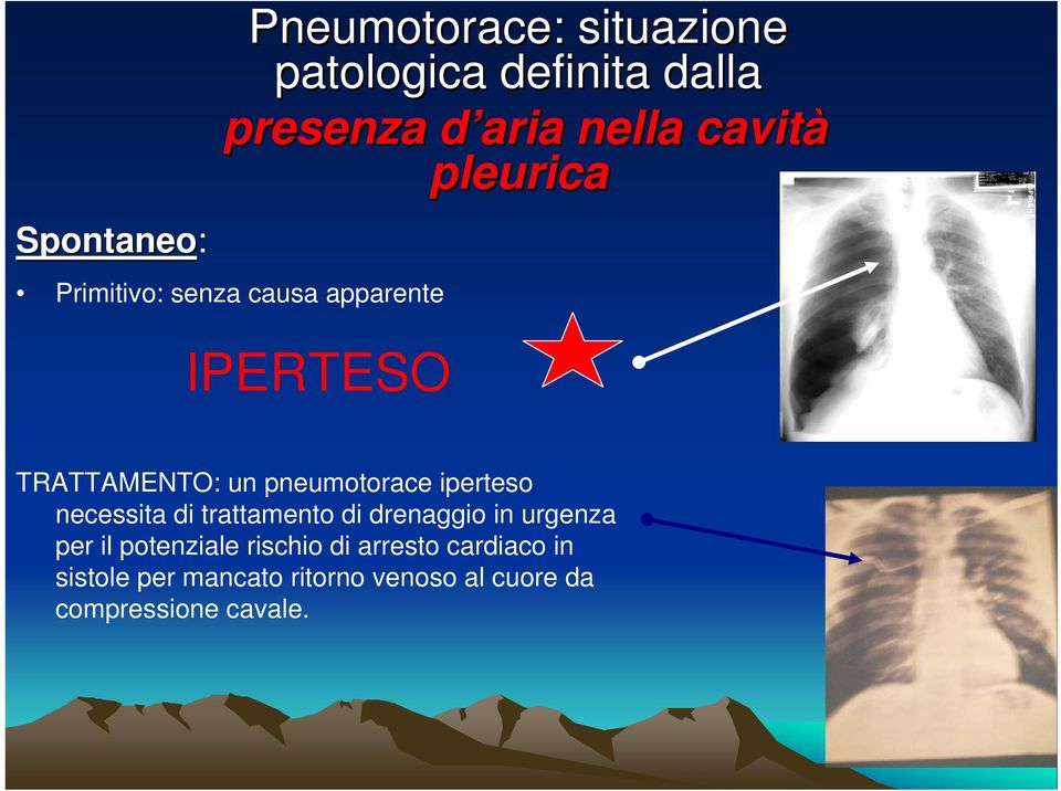 trattamento di drenaggio in urgenza per il potenziale rischio di