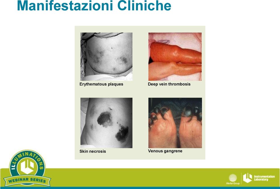 Deep vein thrombosis