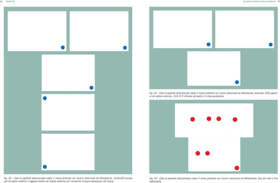 016 Ni-Ti inferiore ed elastici di intercuspidazione. Fig. 32 Caso di paziente disfunzionale classe II morso profondo con incisivi retroclinati ed affollamento:.