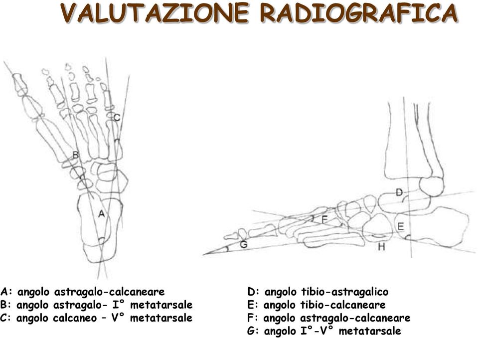 metatarsale D: angolo tibio-astragalico E: angolo