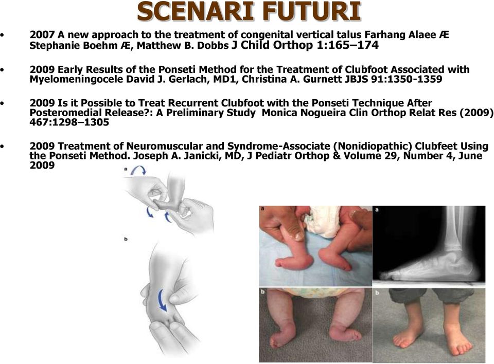 Gurnett JBJS 91:1350-1359 2009 Is it Possible to Treat Recurrent Clubfoot with the Ponseti Technique After Posteromedial Release?