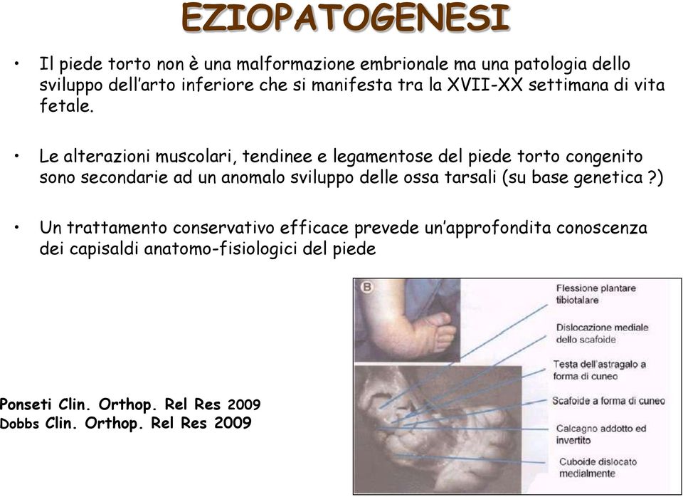 Le alterazioni muscolari, tendinee e legamentose del piede torto congenito sono secondarie ad un anomalo sviluppo delle ossa