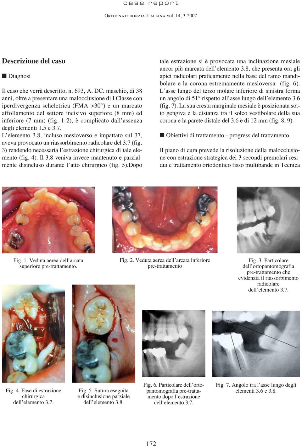 (fig. 1-2), è complicato dall assenza degli elementi 1.5 e 3.7. L elemento 3.8, incluso mesioverso e impattato sul 37, aveva provocato un riassorbimento radicolare del 3.7 (fig.