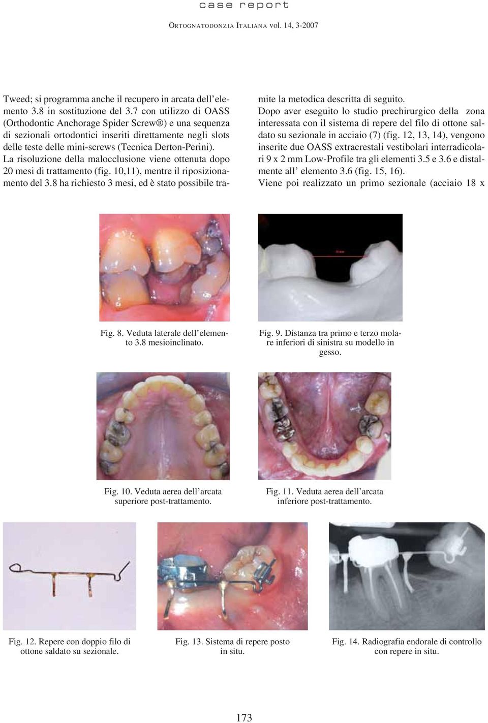 La risoluzione della malocclusione viene ottenuta dopo 20 mesi di trattamento (fig. 10,11), mentre il riposizionamento del 3.