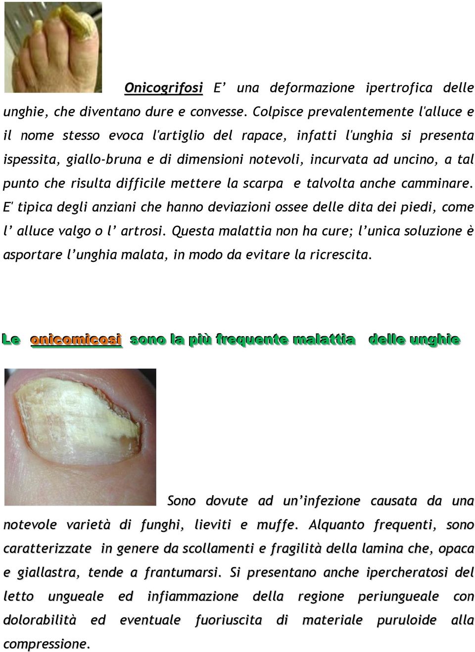 risulta difficile mettere la scarpa e talvolta anche camminare. E' tipica degli anziani che hanno deviazioni ossee delle dita dei piedi, come l alluce valgo o l artrosi.