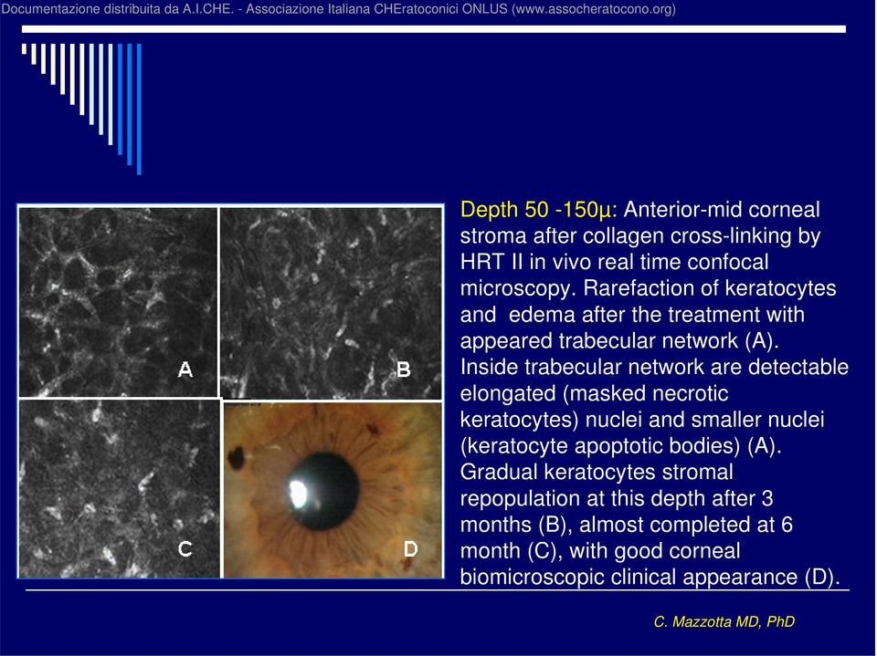 Inside trabecular network are detectable elongated (masked necrotic keratocytes) nuclei and smaller nuclei (keratocyte apoptotic