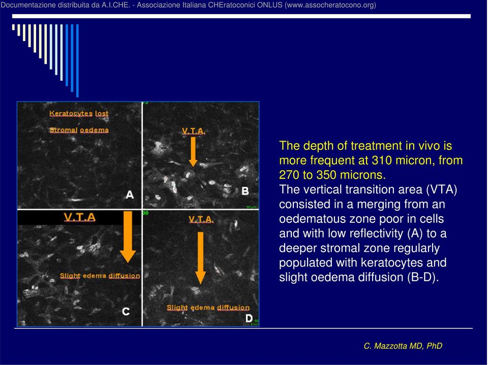 The vertical transition area (VTA) consisted in a merging from an oedematous