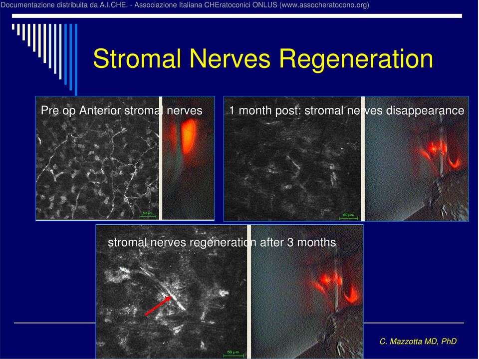 post: stromal nerves disappearance