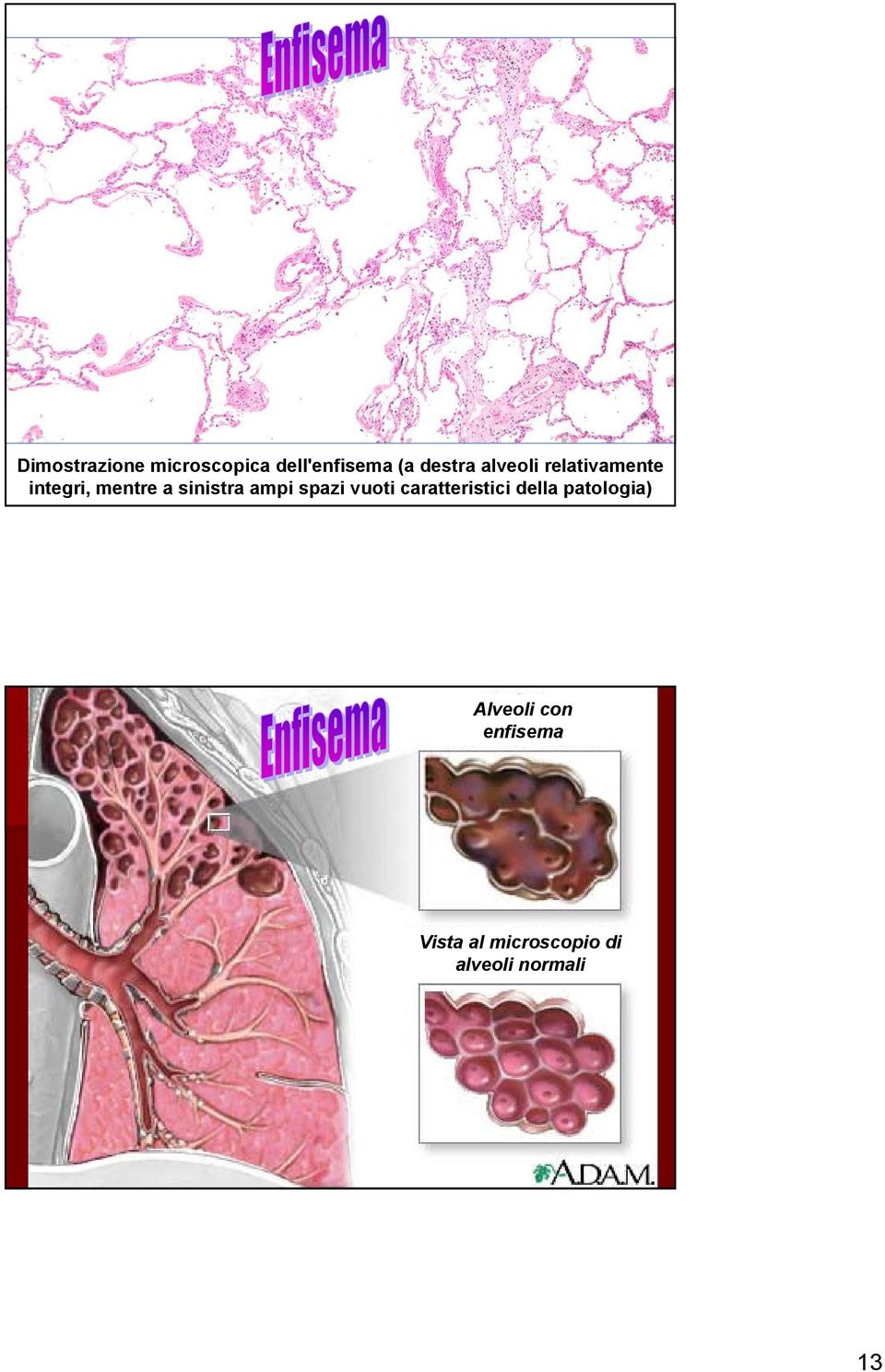 spazi vuoti caratteristici della patologia) Alveoli