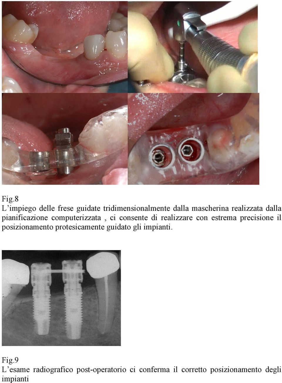 estrema precisione il posizionamento protesicamente guidato gli impianti. Fig.