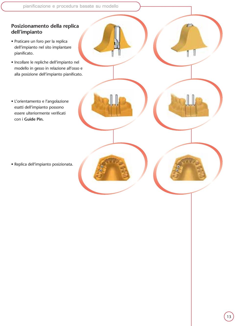 Incollare le repliche dell impianto nel modello in gesso in relazione all osso e alla posizione dell impianto