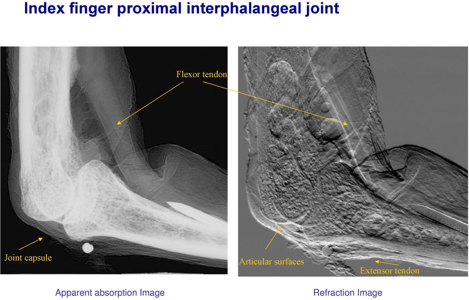 Articular surfaces Extensor tendon