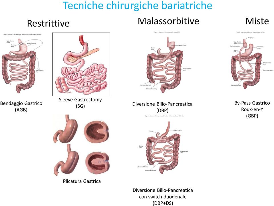 Diversione Bilio-Pancreatica (DBP) By-Pass Gastrico Roux-en-Y