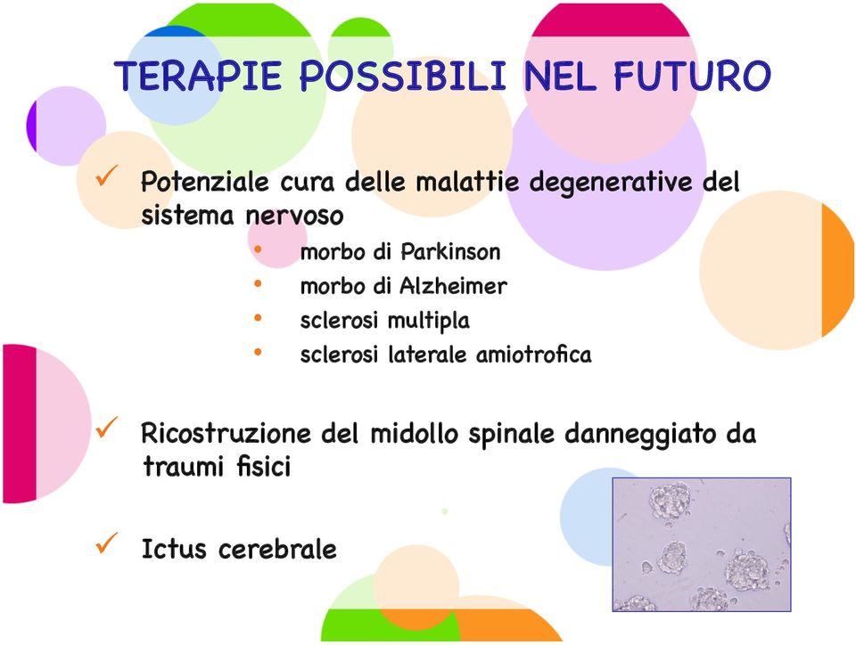 Alzheimer sclerosi multipla sclerosi laterale amiotrofica ü