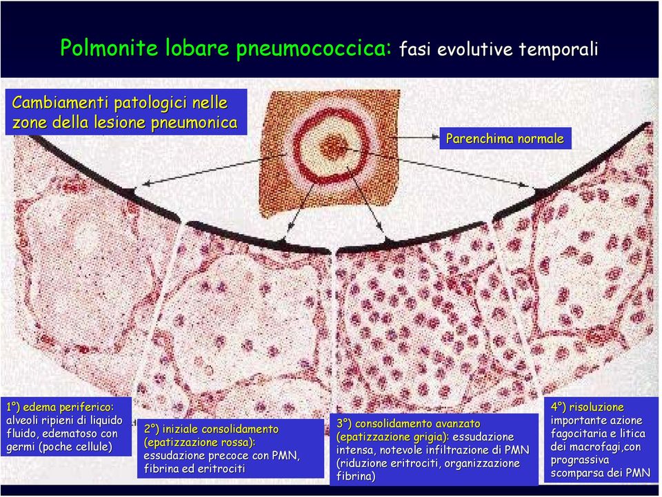 precoce con PMN, fibrina ed eritrociti 3 ) ) consolidamento avanzato (epatizzazione grigia): essudazione intensa, notevole infiltrazione di PMN