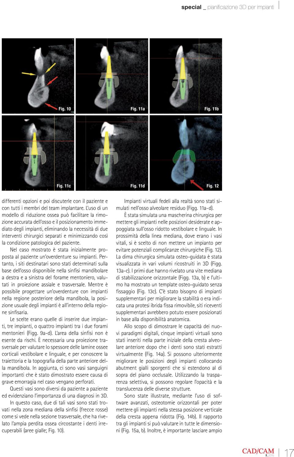 minimizzando così la condizione patologica del paziente. Nel caso mostrato è stata inizialmente proposta al paziente un overdenture su impianti.