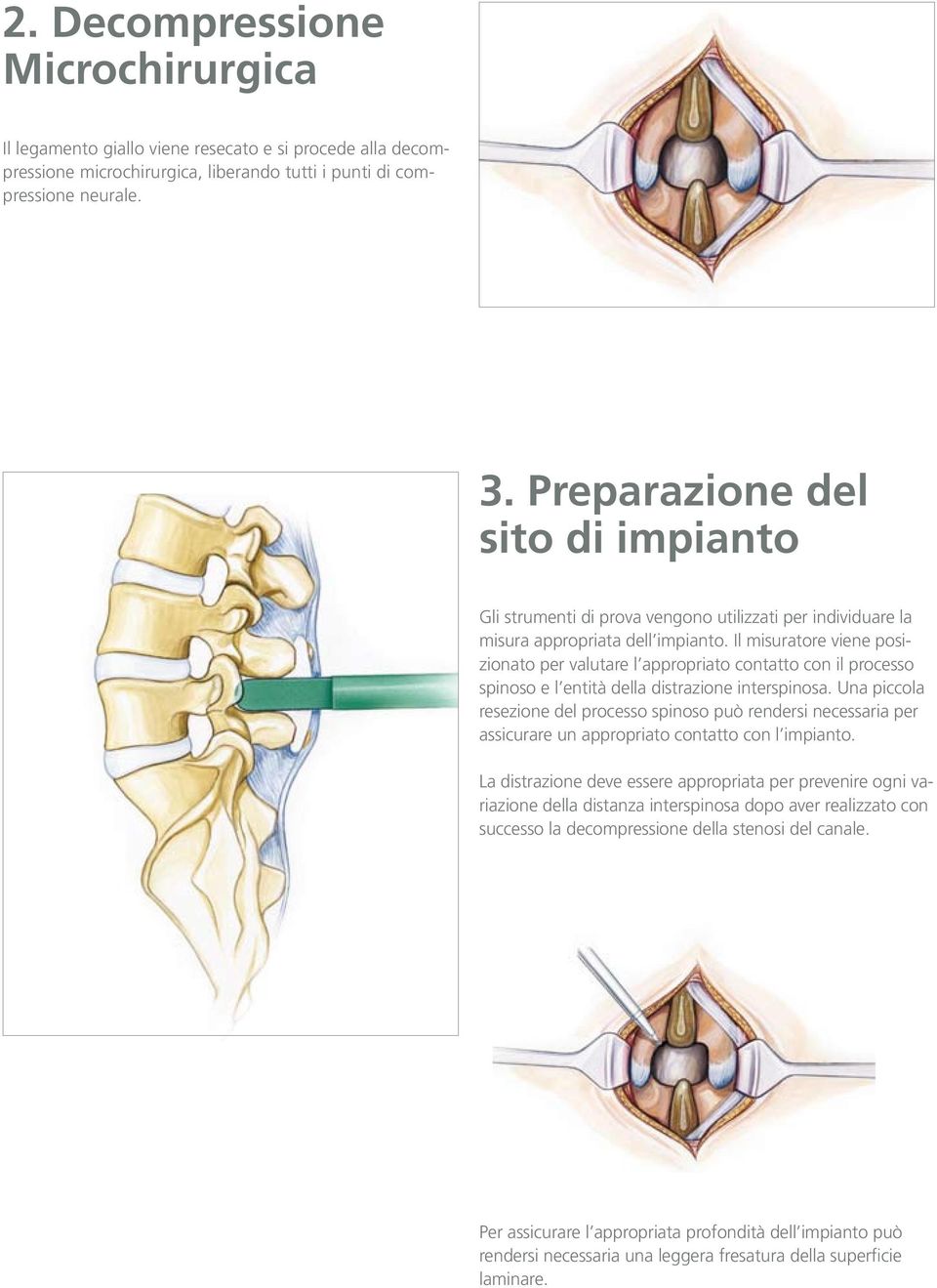 Il misuratore viene posizionato per valutare l appropriato contatto con il processo spinoso e l entità della distrazione interspinosa.