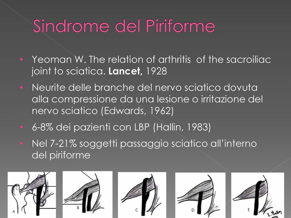 da una lesione o irritazione del nervo sciatico (Edwards, 1962) 6-8% dei