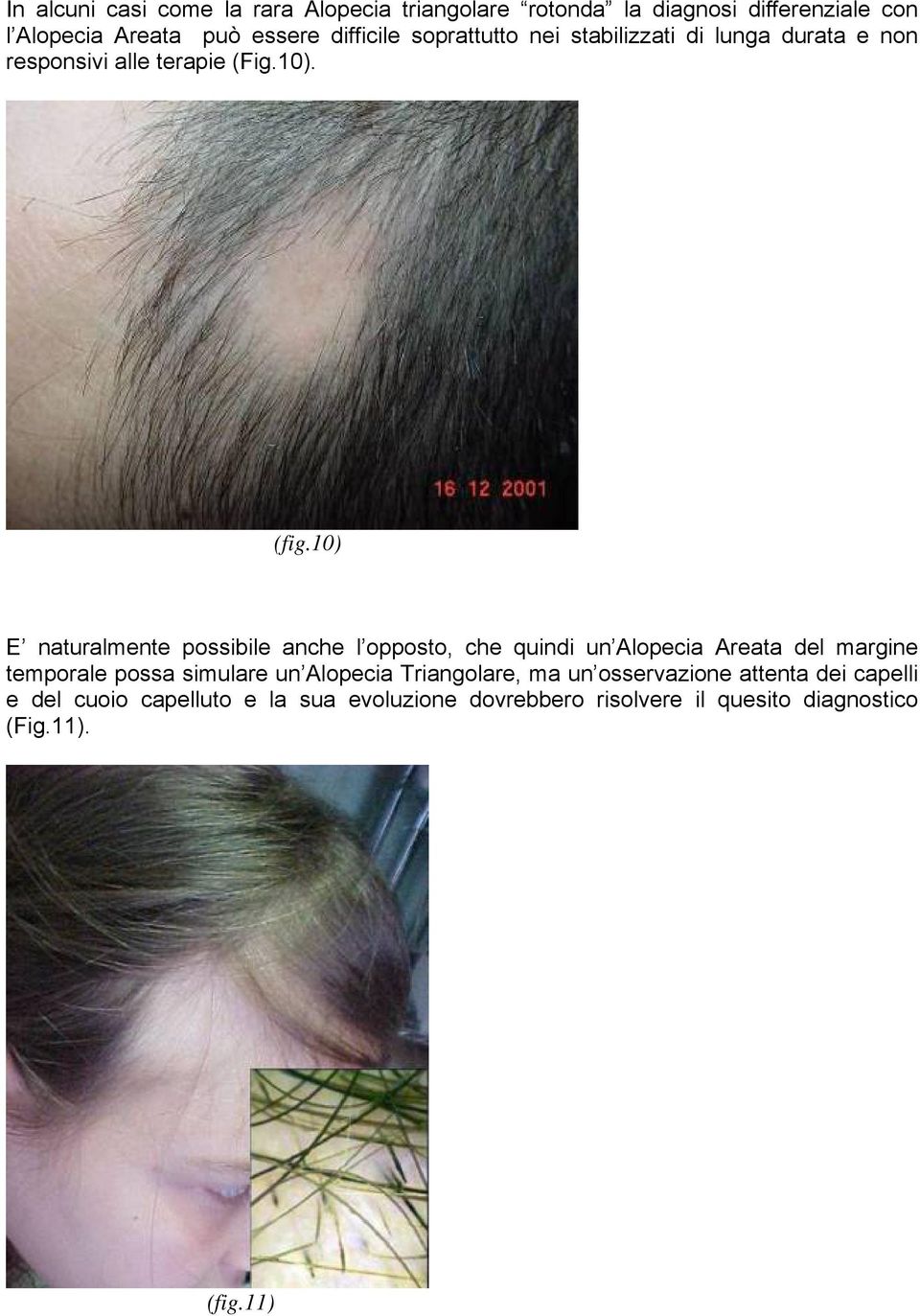 10) E naturalmente possibile anche l opposto, che quindi un Alopecia Areata del margine temporale possa simulare un Alopecia
