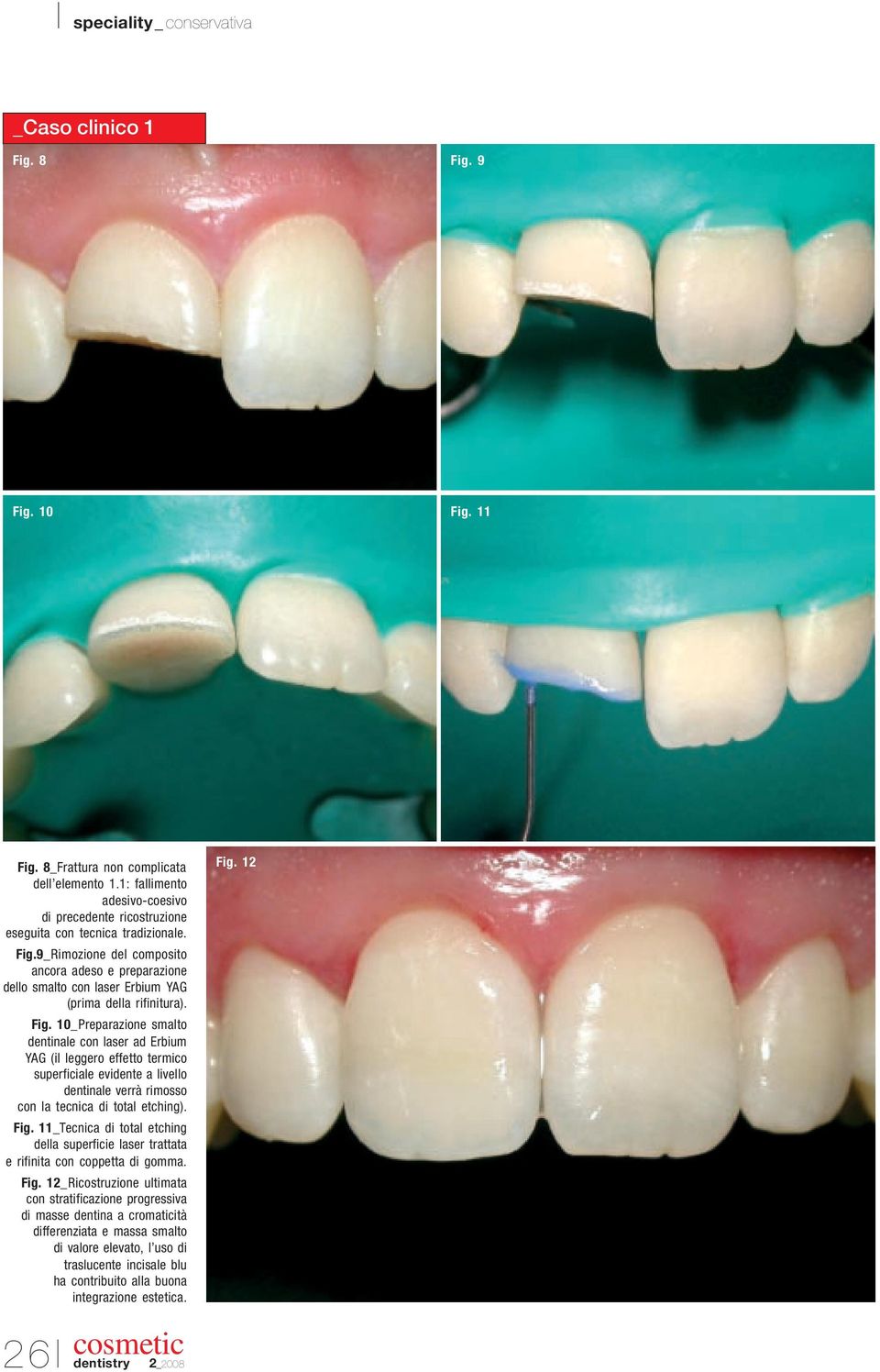 11_Tecnica di total etching della superficie laser trattata e rifinita con coppetta di gomma. Fig.