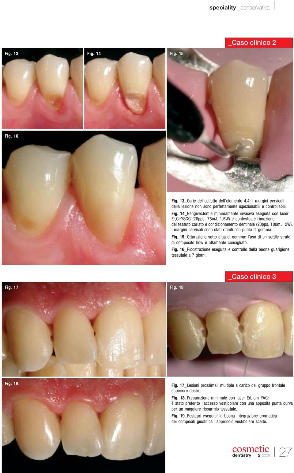 14_Gengivectomia minimamente invasiva eseguita con laser Er,Cr:YSGG (20pps, 75mJ, 1,5W) e contestuale rimozione del tessuto cariato e condizionamento dentinale (20pps, 100mJ, 2W).