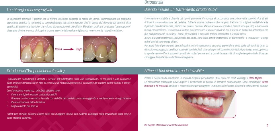 Si tratta in pratica di un piccolo autotrapianto di gengiva che ha lo scopo di ricoprire la zona esposta della radice migliorando notevolmente l aspetto estetico.