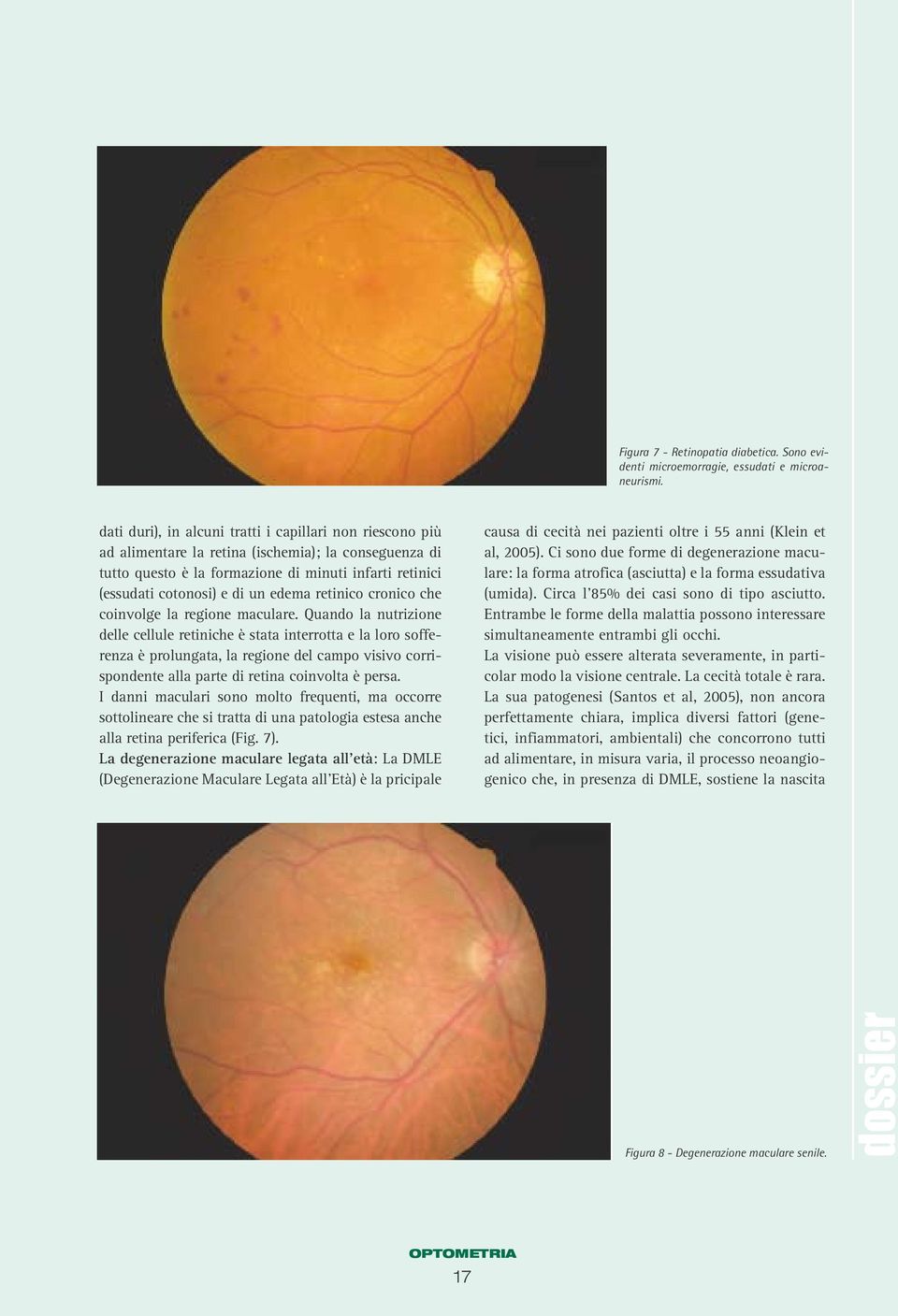 edema retinico cronico che coinvolge la regione maculare.
