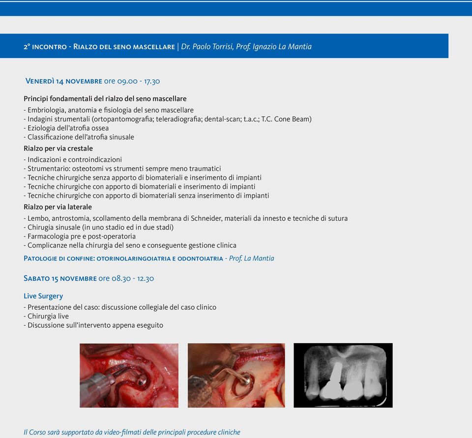 Cone Beam) - Eziologia dell atrofia ossea - Classificazione dell atrofia sinusale Rialzo per via crestale - Indicazioni e controindicazioni - Strumentario: osteotomi vs strumenti sempre meno