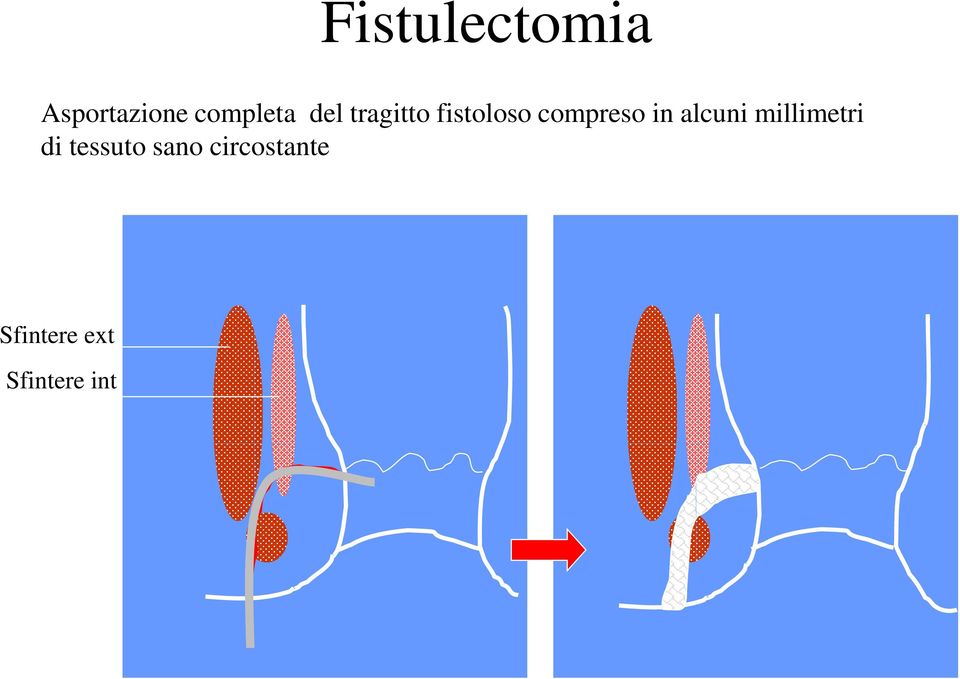 alcuni millimetri di tessuto sano